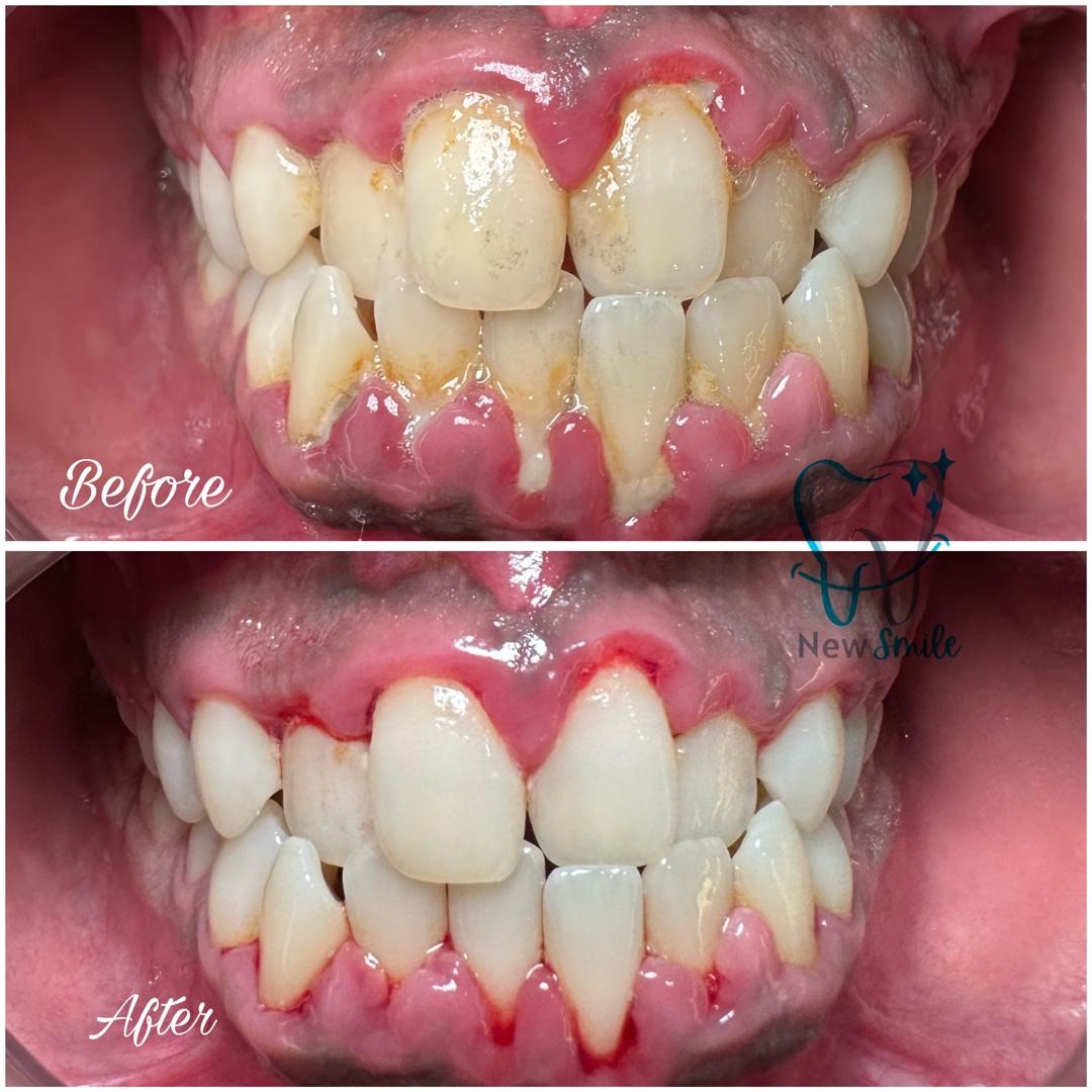 newsmile-scaling-polishing